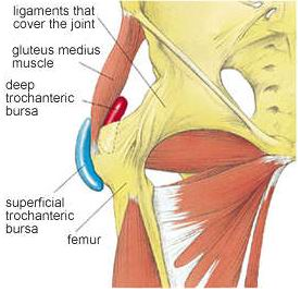 Trochanteric Bursitis 2.JPG